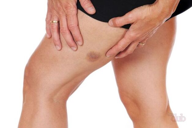 wenn eine Vene platzt